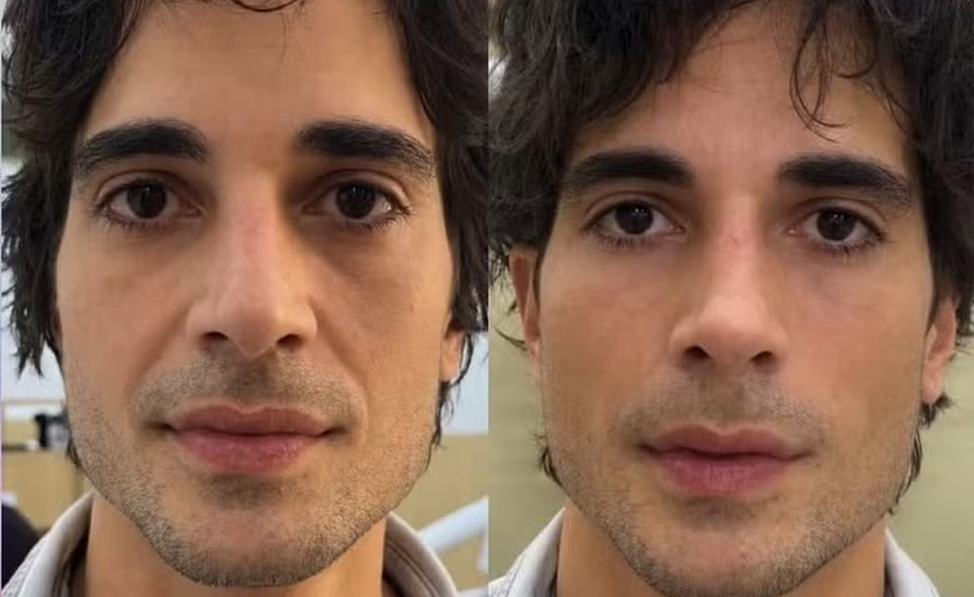 Antes e depois da Harmonização Facial do Fiuk