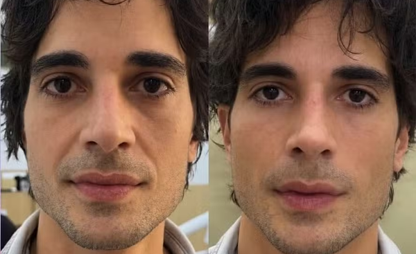 Antes e depois da Harmonização Facial do Fiuk